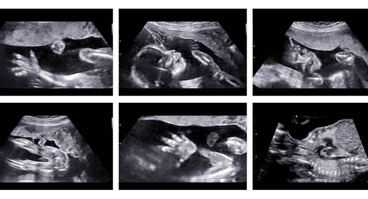 Diagnóstico prenatal de anomalías congénitas fetales Diagnóstico prenatal de anomalías congénitas fetales